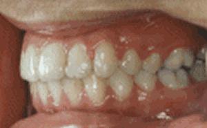 为什么整牙脸会小,为什么整牙期间脸会变老