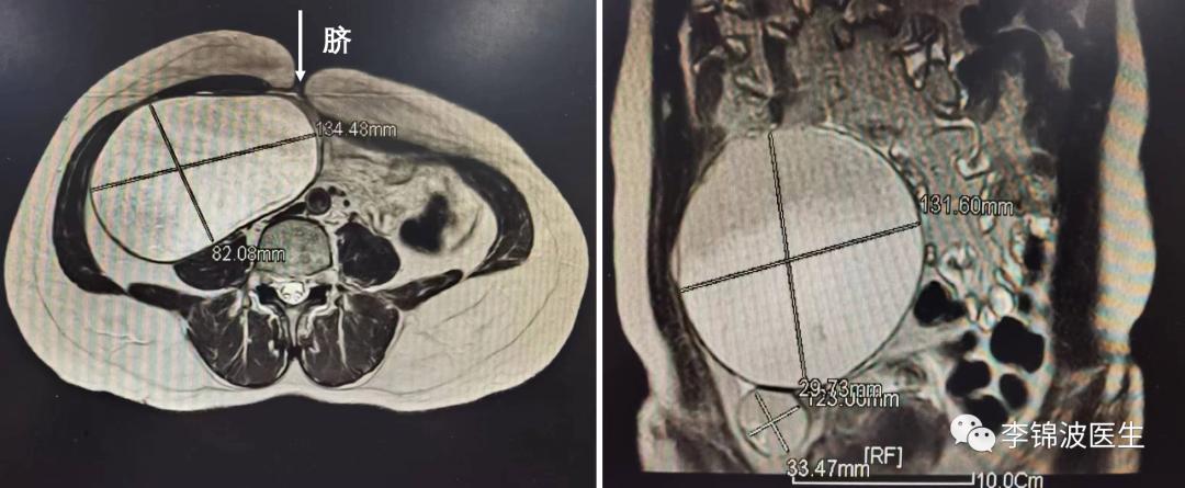 10公分的卵巢囊肿开腹好还是微创,卵巢囊肿大怎样动手术