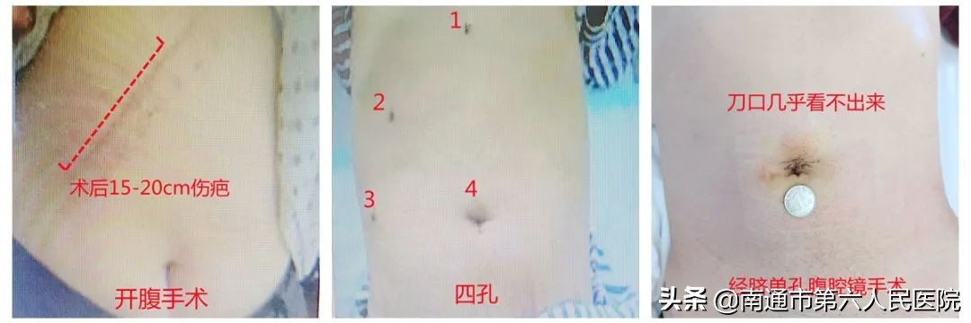 阑尾炎微创手术肚脐眼有四个点,微创阑尾炎肚脐眼
