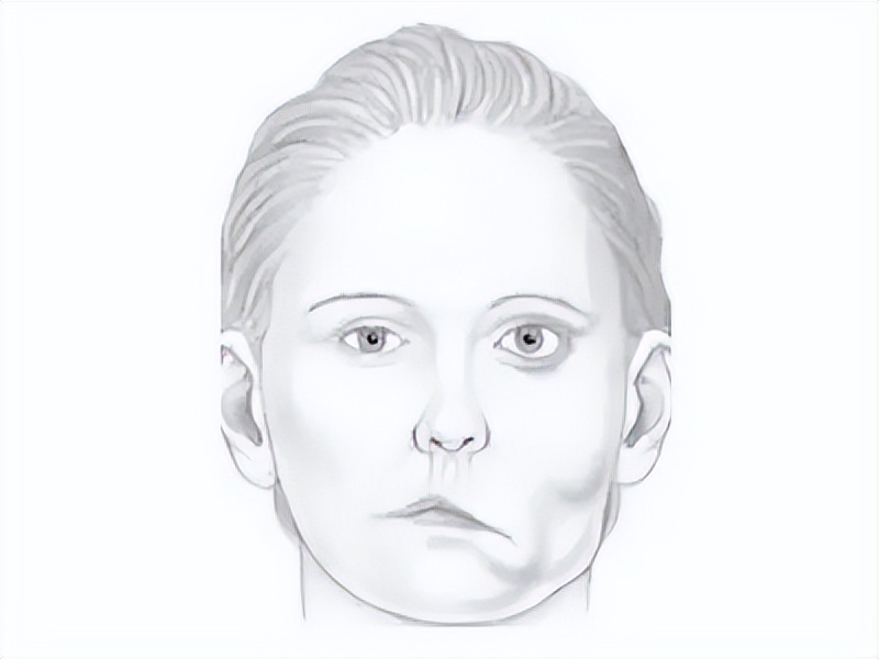 女子胃痛后面瘫，疑似神经发炎，做了高压氧，直到瘫痪才找到病因