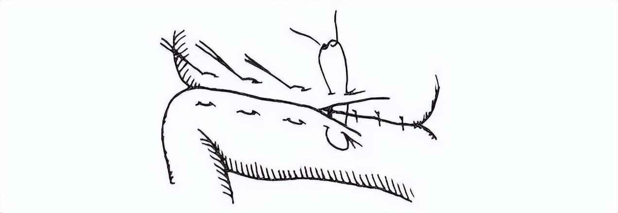 外科各种缝合方法的适用情况,外科操作缝合