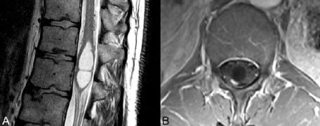 原发性肝癌的磁共振影像诊断,原发性腰椎肿瘤有哪些
