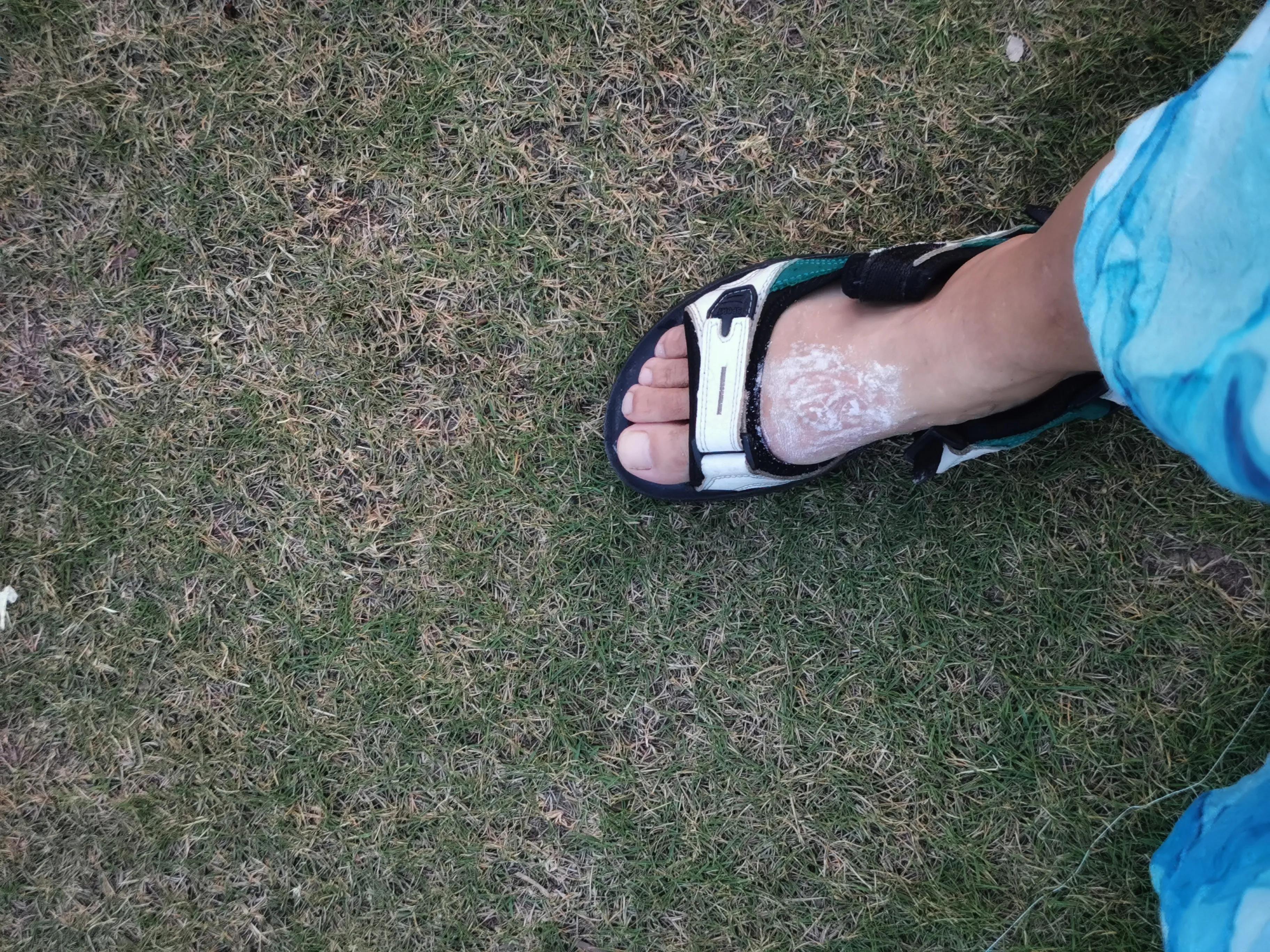 被蓑衣虫咬了一口之后我是如何处理的