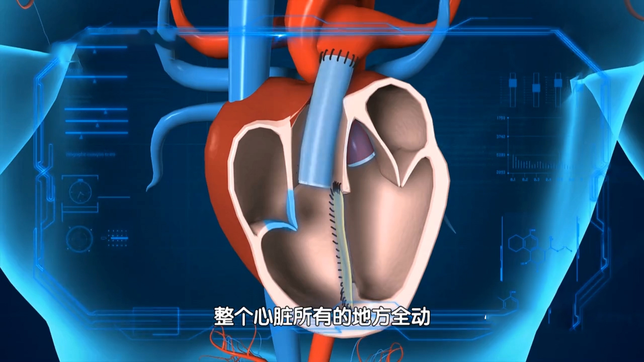 心脏发育畸形,九岁男孩经历四次心脏手术