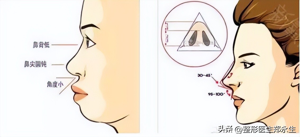 丑鼻子如何变成好看的鼻子,什么样的鼻子让人难看