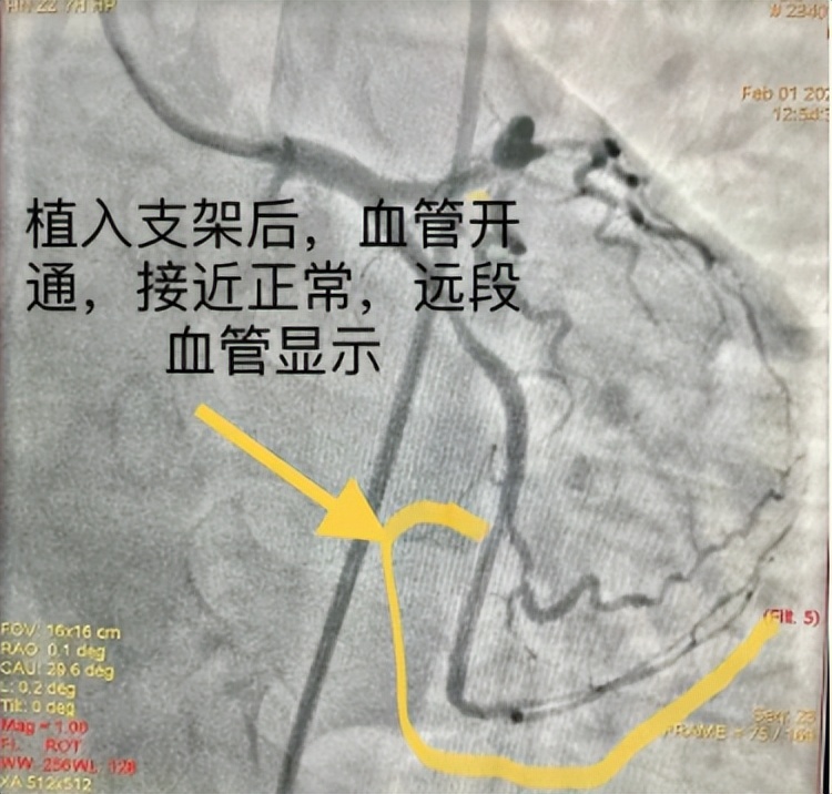 媒体聚焦丨一天一包烟，患上心绞痛！