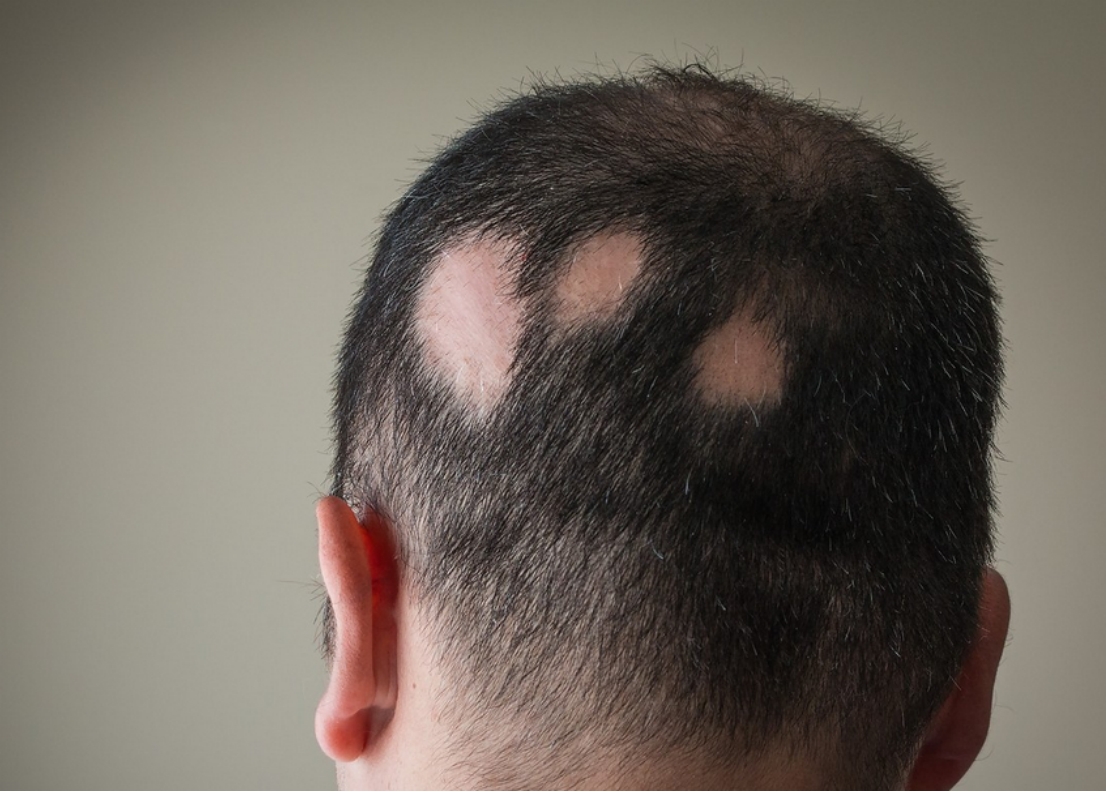 怎么脱发最有效果,怎么样脱发才算严重