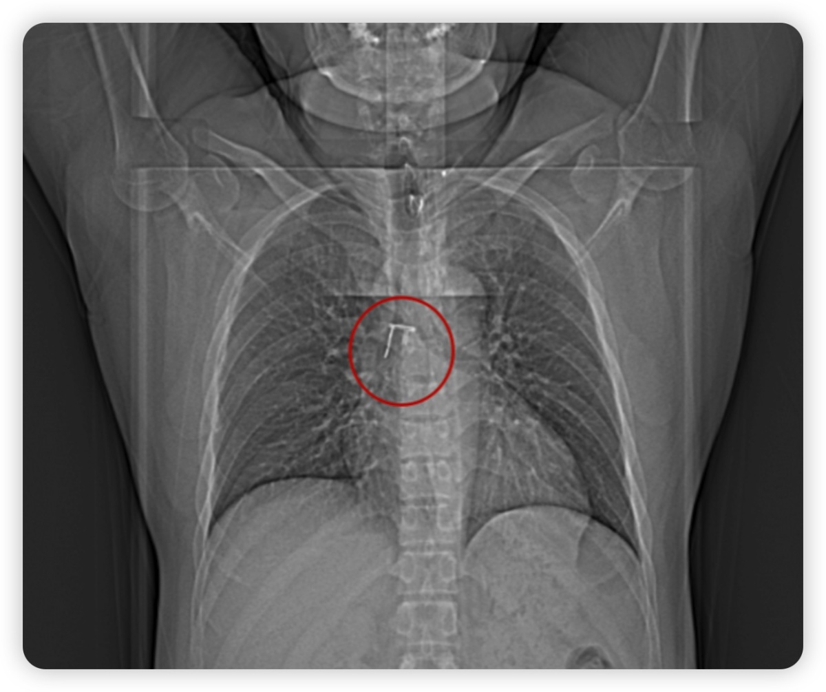 小儿做支气管镜能取出异物吗,医院支气管镜取出异物多少钱