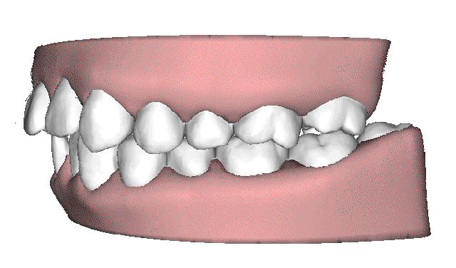 一颗牙长歪矫正要花多少钱,14岁牙歪了怎么自己矫正