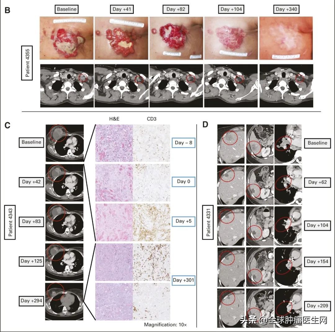 晚期乳腺癌成功抗癌的案例,乳腺癌免疫治疗晚期癌症的治愈率