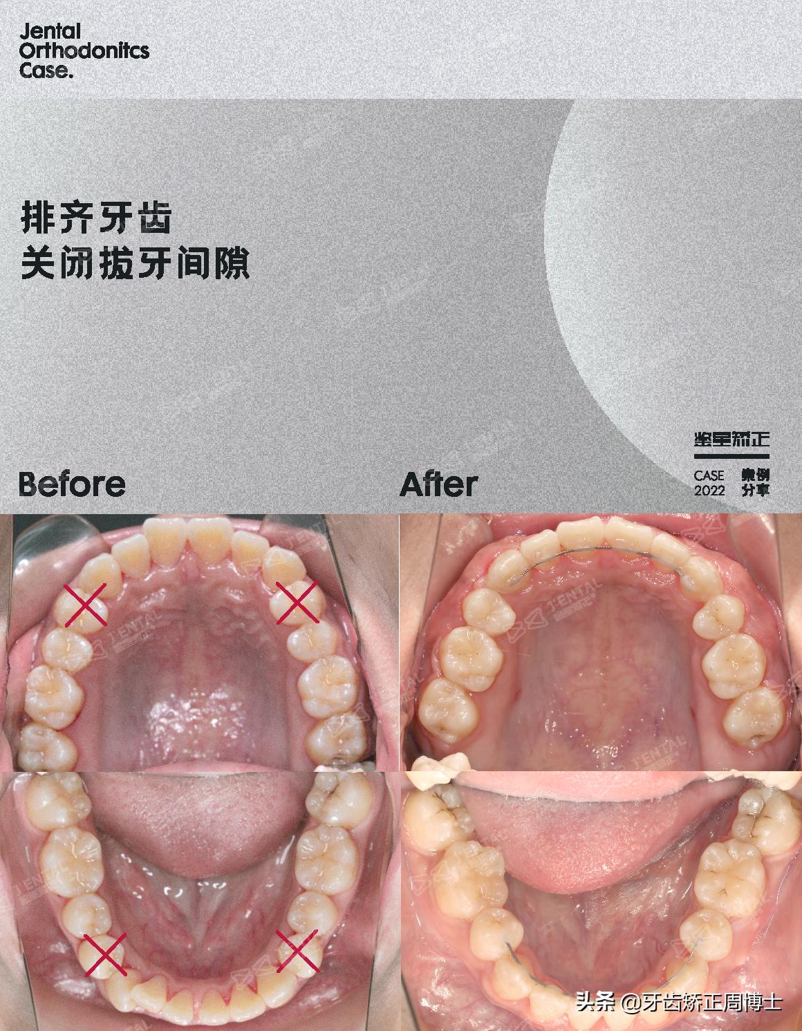 上唇短露牙龈骨性突出矫正训练,骨性前突牙龈照片