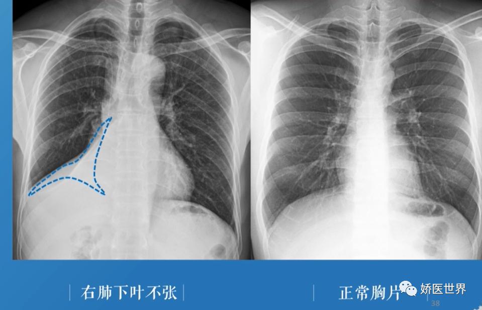 慢性阻塞性肺病肺不张,阻塞性肺不张会出现的临床症状