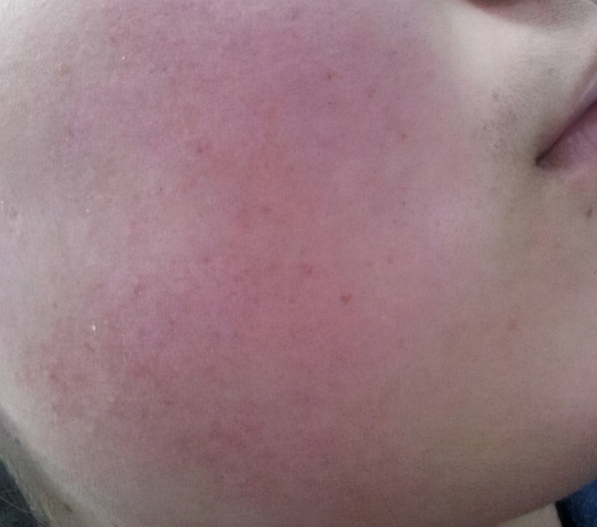 怎么能让红血丝没脸上的红血丝,怎样消除红血丝