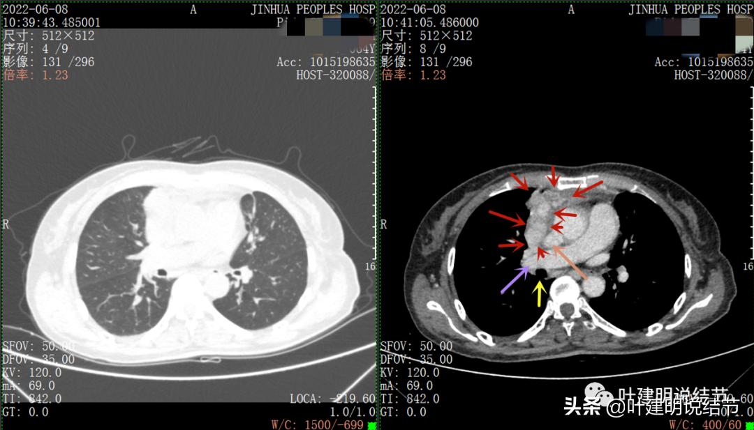 这位老乡，乏力来查，查出这么大个的纵隔肿瘤！会是什么呢？