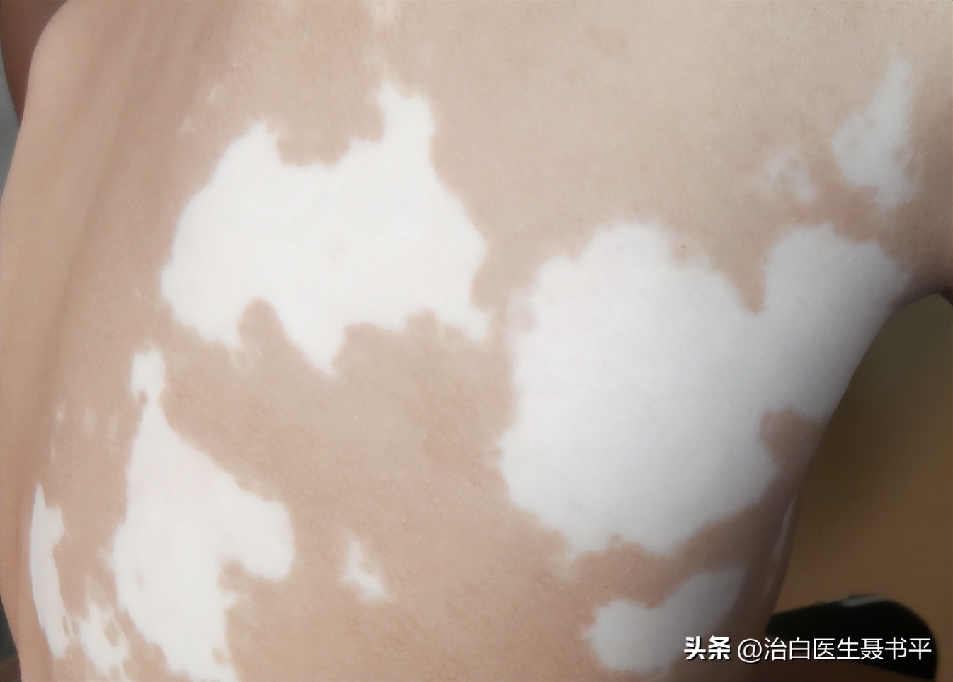 大面积的白癜风怎样才能治愈,大面积白癜风照308贵吗