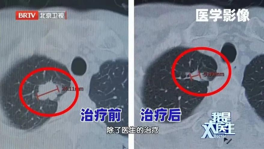 肺癌晚期肺部的变化,肺癌早期到晚期的肺部变化