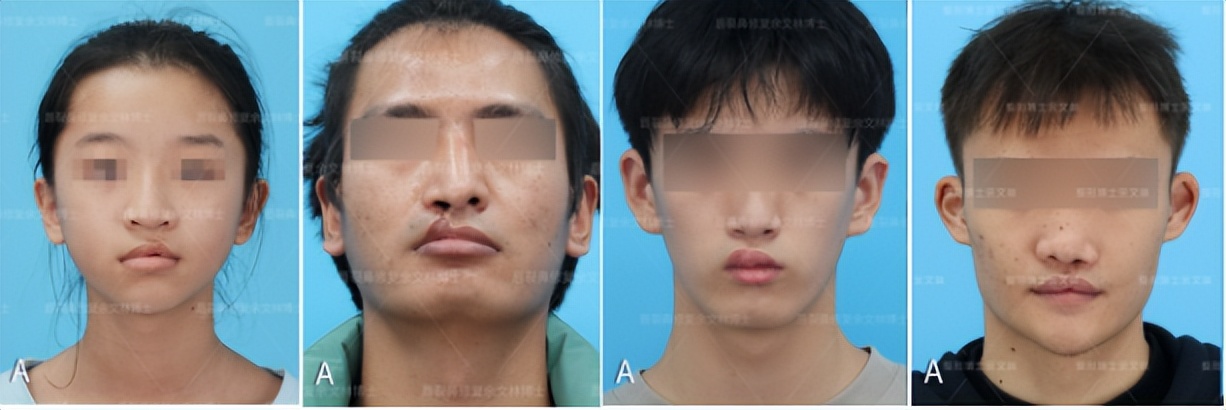 兔唇可以修复吗,兔唇修复能和正常人一样吗