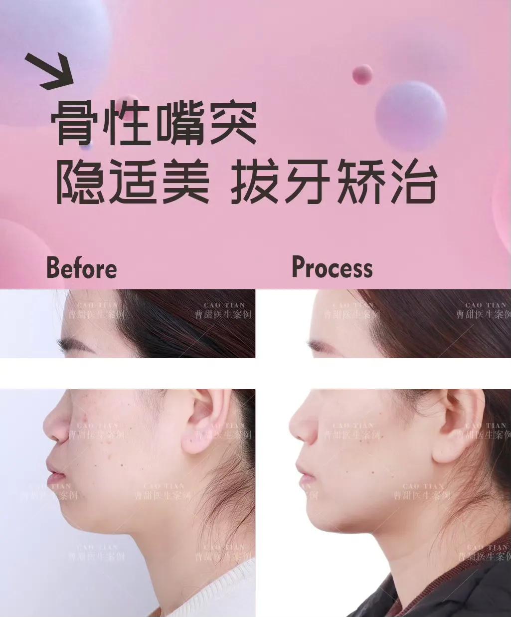 隐适美牙套脸型变化,戴隐适美牙套