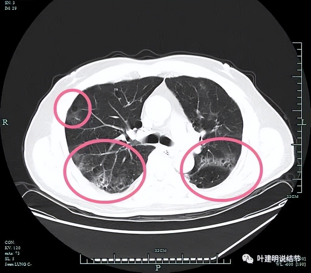 pet判断淋巴结转移,petct判断癌有没有转移准确吗