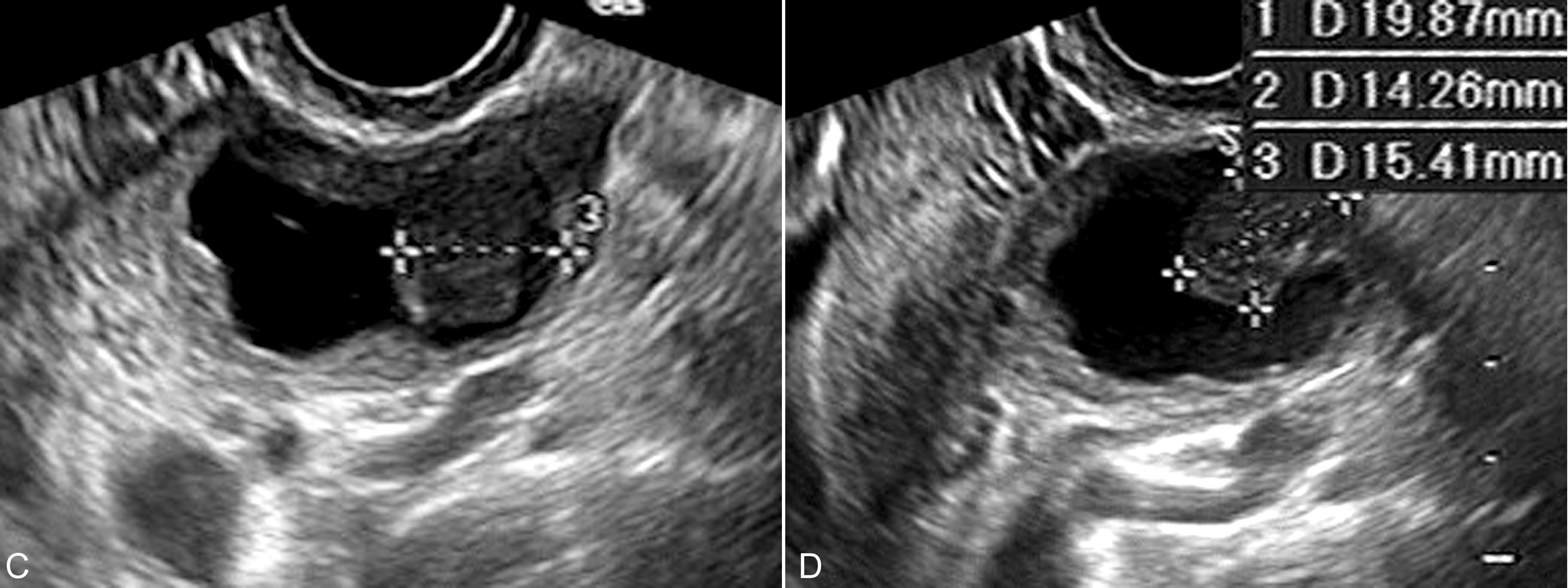 怀孕检查卵巢肿瘤良性恶性几率,妊娠合并卵巢肿瘤的鉴别诊断