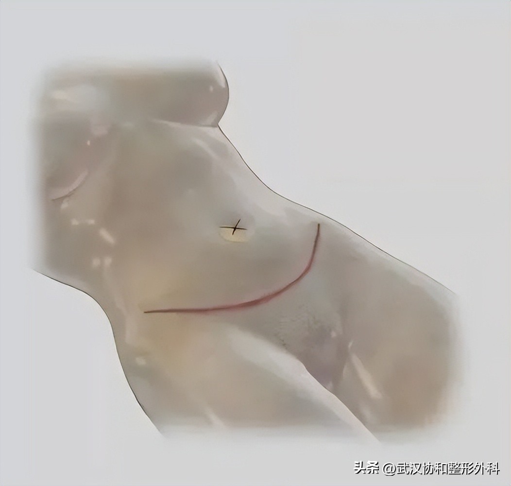 腹壁整形需要咨询问题,腹壁整形术亲身经历分享