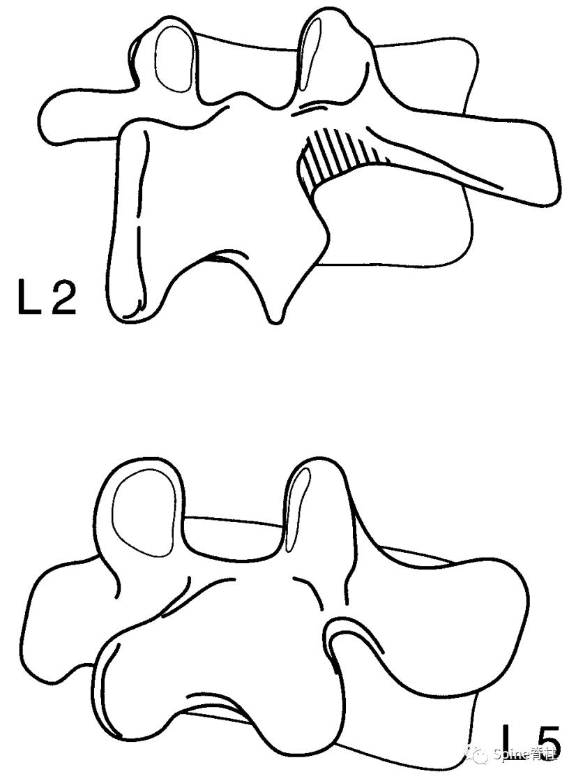 轻度峡部裂和重度峡部裂的区别,真性峡部裂和假性峡部裂