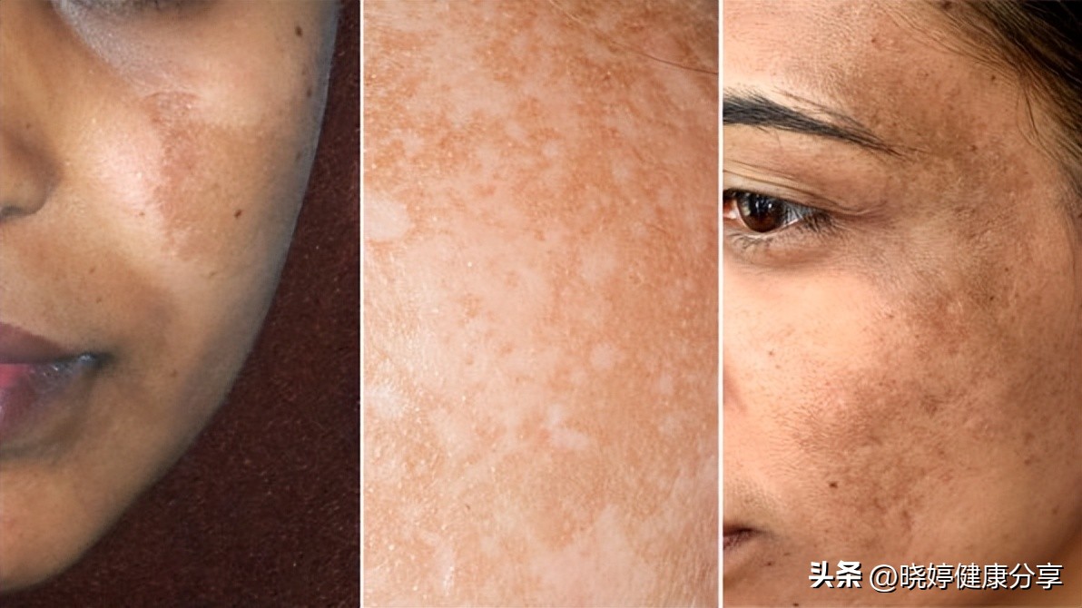 怀孕乳房旁边皮肤变黑是怎么回事,怀孕后腋窝变黑还有斑点