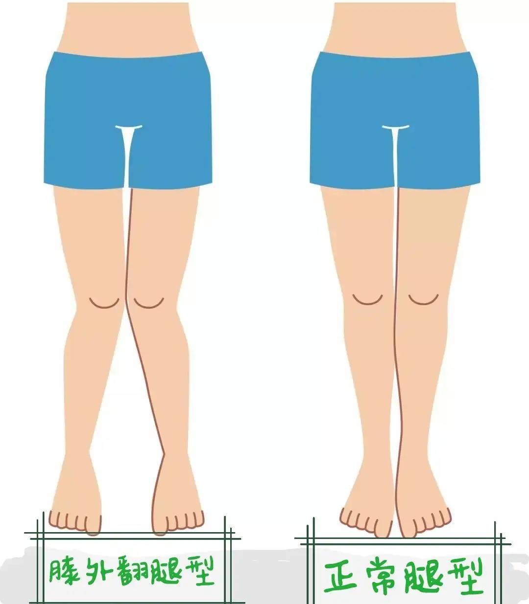 膝外翻畸形的症状,膝外翻怎么治疗