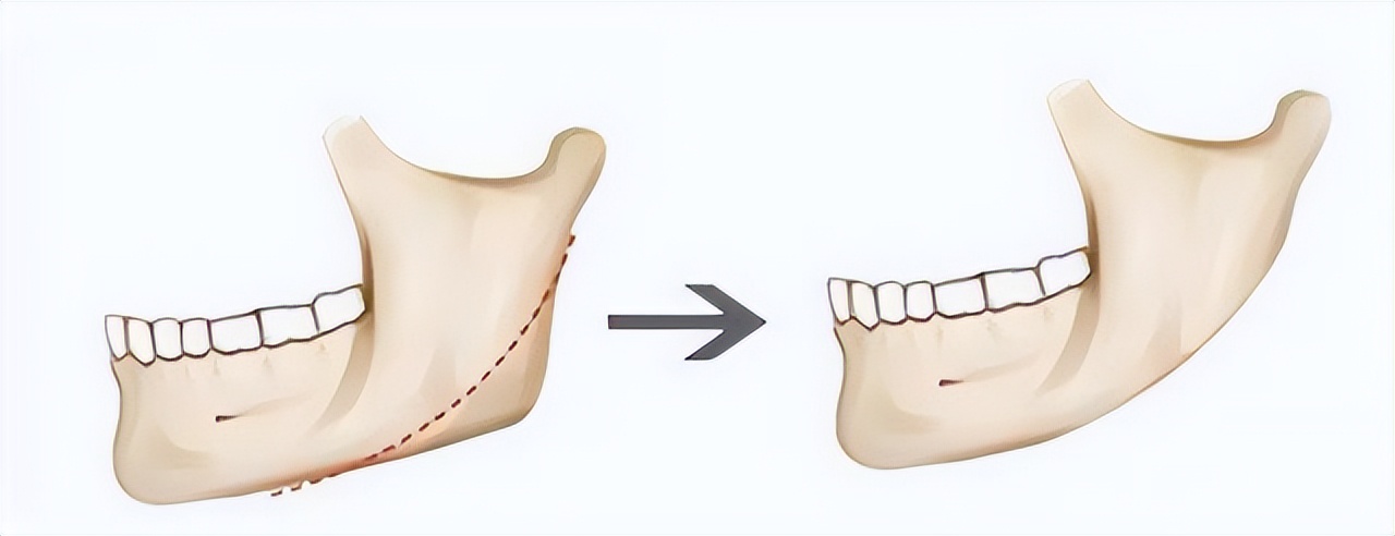 整容脸老了以后会怎么样,整容脸会一直维持一个样子吗