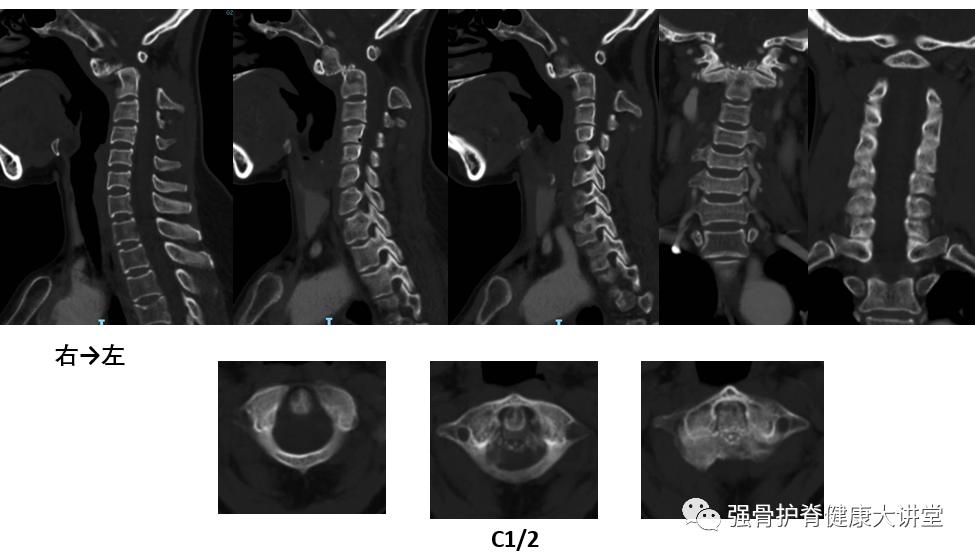 寰枢椎脱位能正骨复位吗,齿状突骨折伴寰枢关节脱位