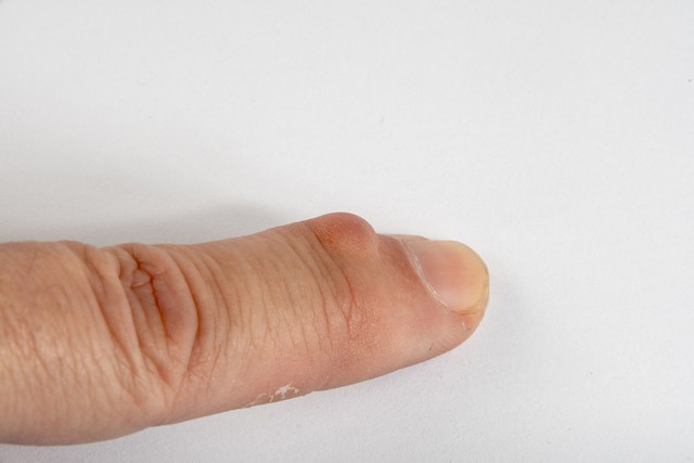 身上慢慢长肉疙瘩是什么病的前兆,身上小肉疙瘩会癌变吗