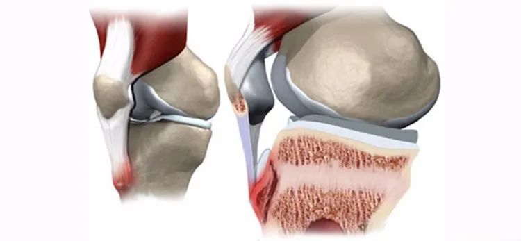 膝盖前面肿了一个包,孩子膝盖上长了一个疙瘩