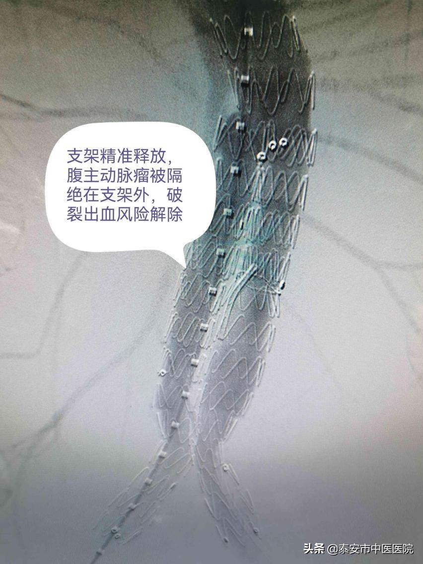 【创新技术】*安泰**市中医医院介入诊疗科：精准影像介入治疗，排除腹主动脉“不定时*弹炸**”