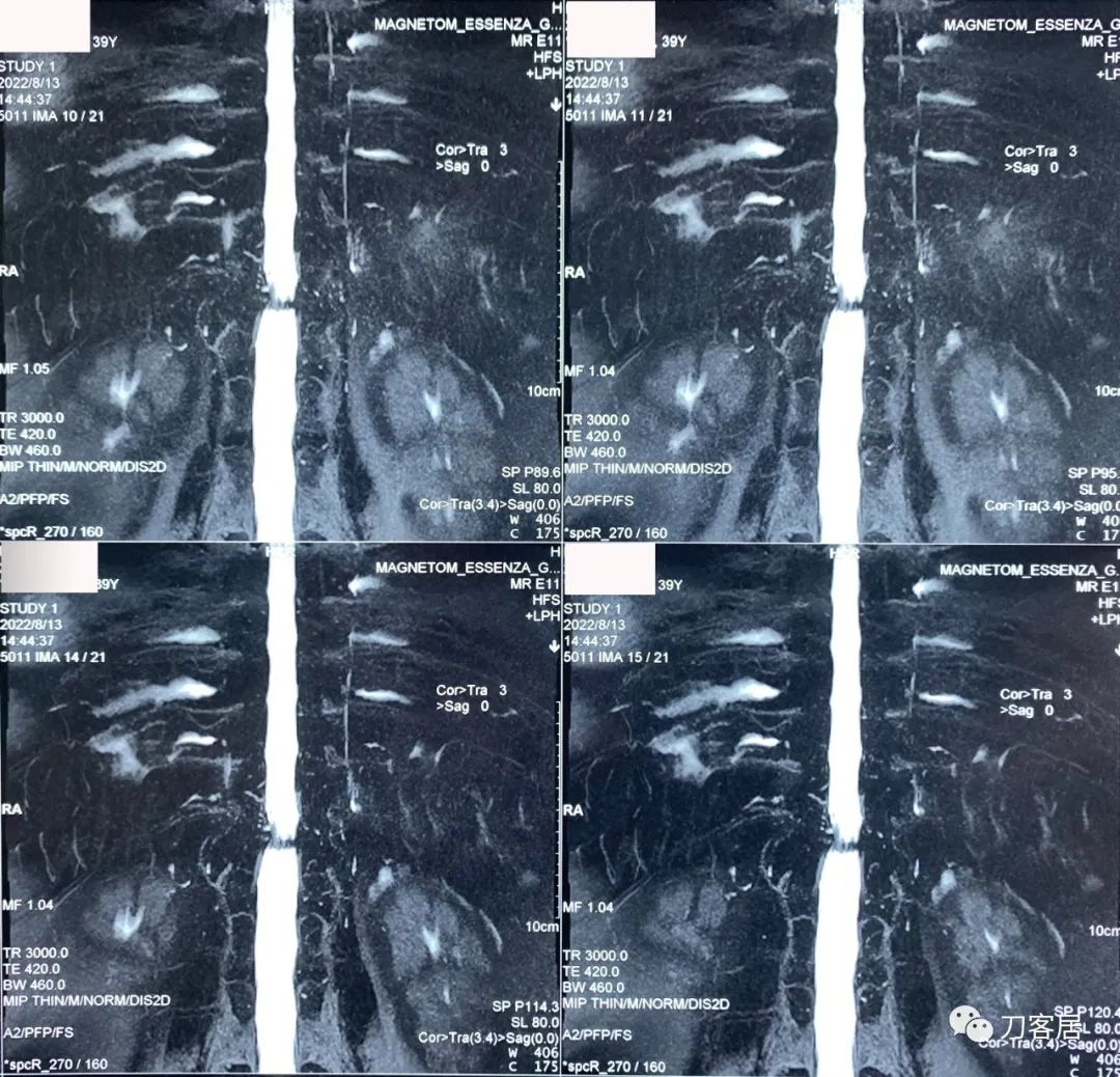 良性单侧下肢肌萎缩,下肢肌肉萎缩24年能治好吗