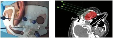 运城肿瘤专家卫毅楠教授开展新一代125-碘粒子植入术肿瘤精准治疗