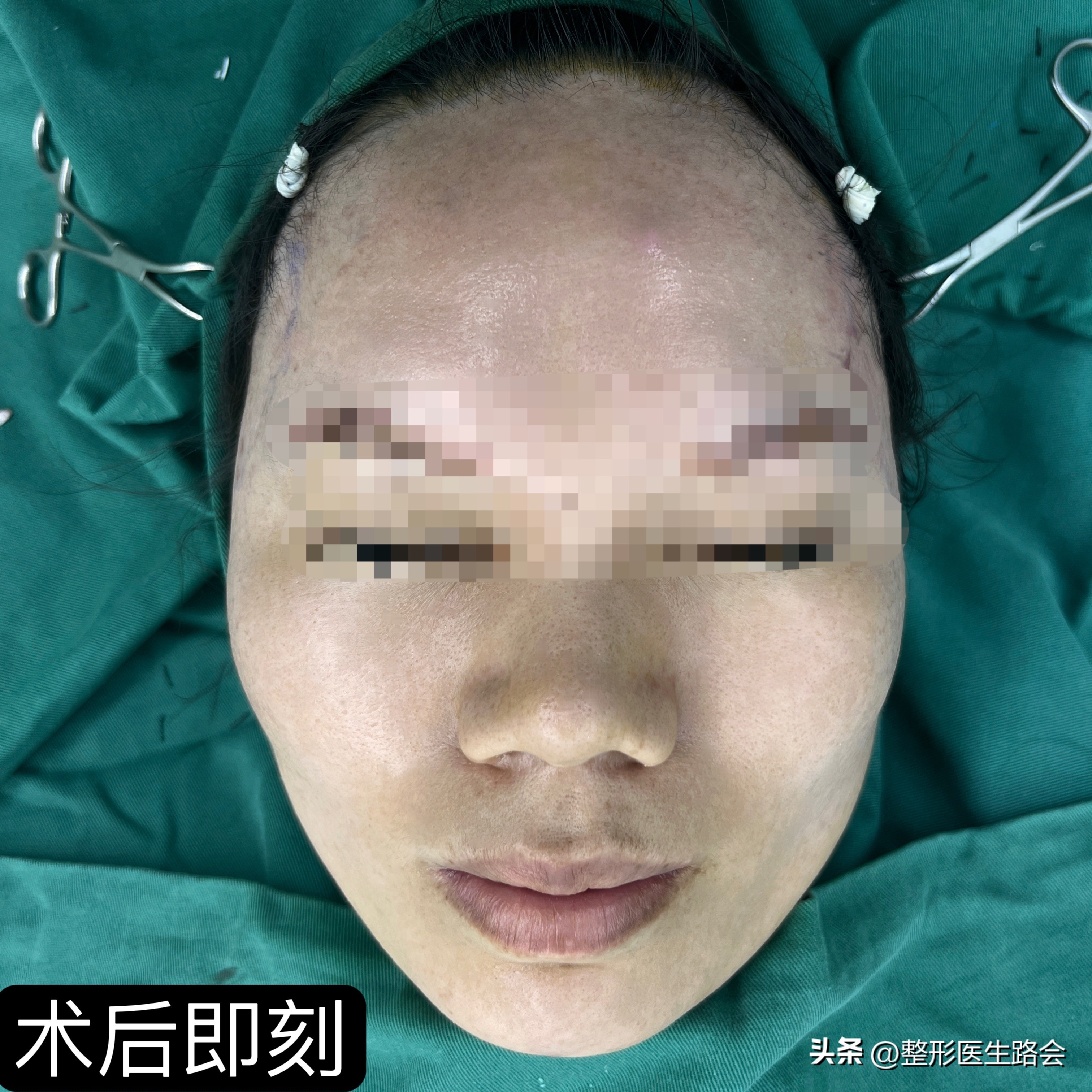 31岁做太阳穴填充,太阳穴填充手术流程