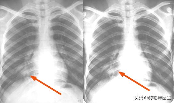 石棉一级致癌物,国际公认一级致癌物石棉有多可怕