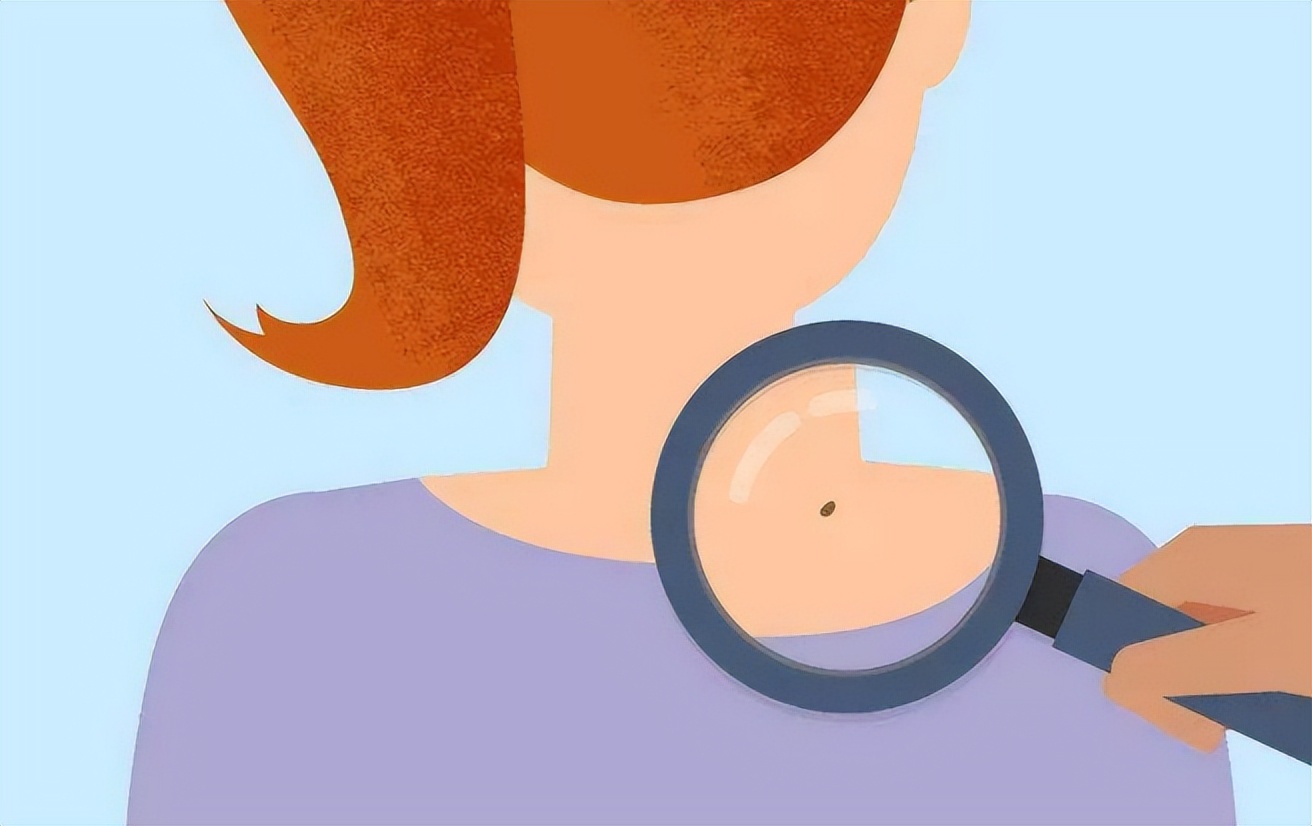 mrna技术预防黑色素瘤,松花粉可以预防黑色素瘤吗