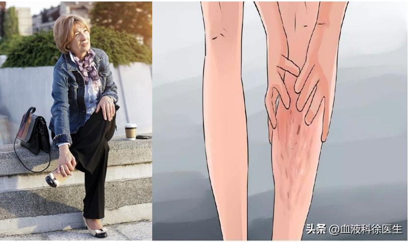 血栓手脚有什么症状和预兆,血栓来临手脚有啥感觉