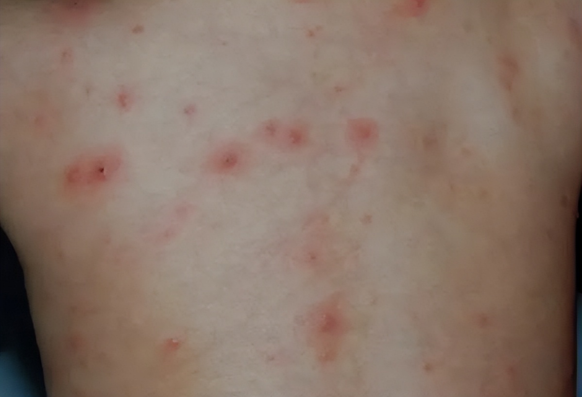 一瓶“甲硝唑”几块钱，或能“摆平”5种常见疾病，你知道几个？