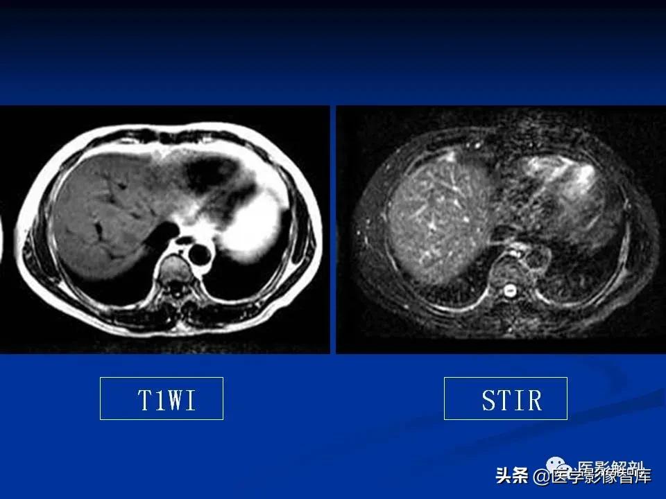 肝炎性假瘤鉴别诊断,肝炎性假瘤影像学表现