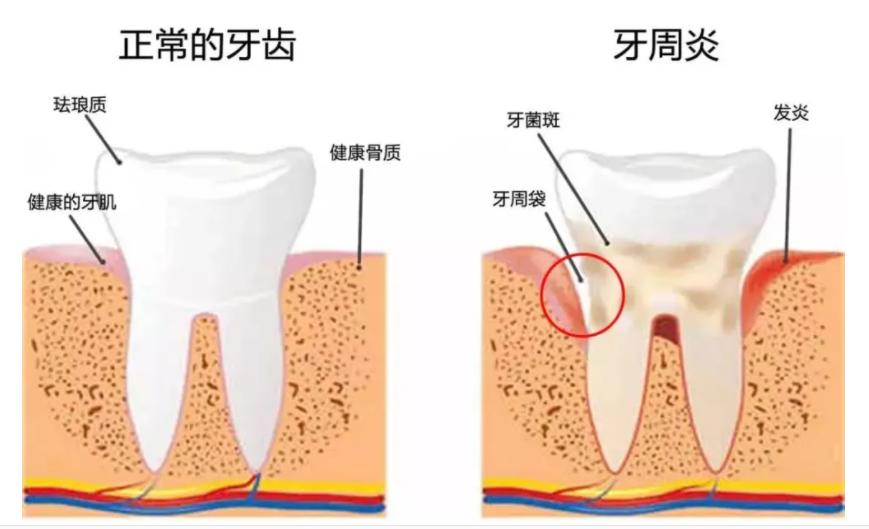 牙周炎犯了不治疗自己会自愈吗,得了牙周炎暂时不能去医院怎么办