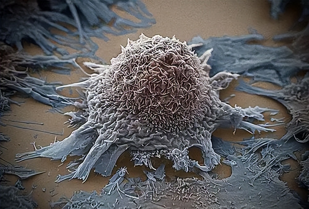 男子长了1000个鸡眼,58岁男性脚底长了一个包一碰就疼