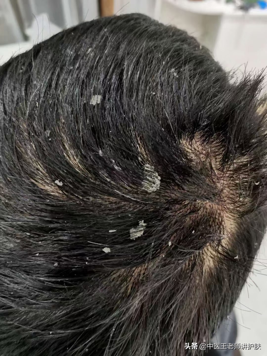 女性脂溢性脱发补肝肾气血有用吗,脂溢性脱发为什么祛风活络