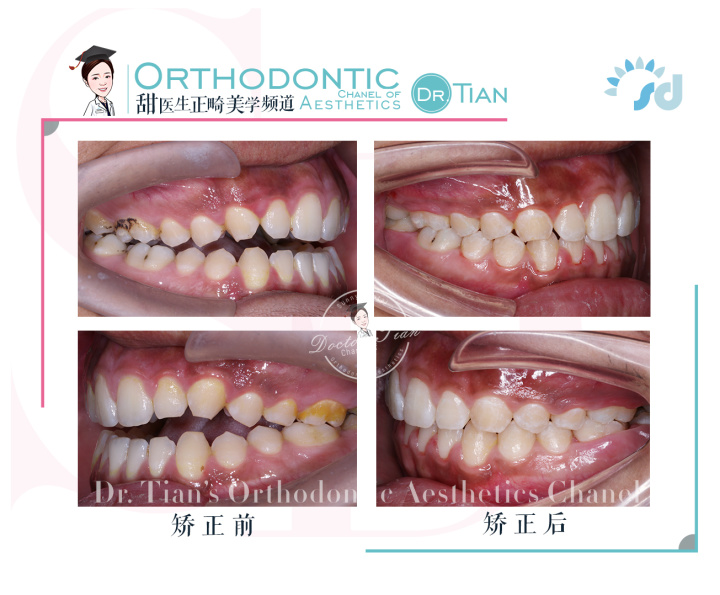 上下牙无法咬合是怎么回事,30岁牙齿咬合开颌还有必要矫正吗