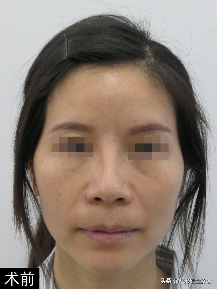 太阳穴做了填充手术第7天,填充太阳穴手术经历