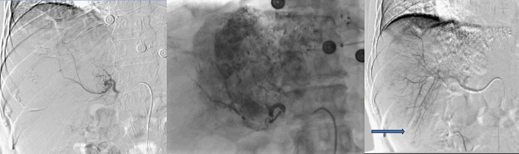 手术治疗癌症会好吗,手术介入化疗效果
