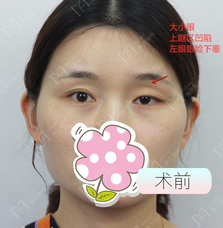 大小眼怎么改善,大小眼严重美睫能改善吗