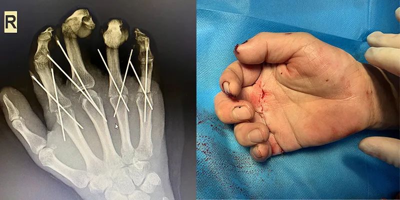 男子右臂意外截肢完整版,男子断指再植