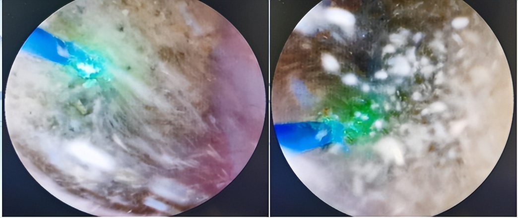 明知山有虎,偏向虎山行——肾斗士VS肾结石